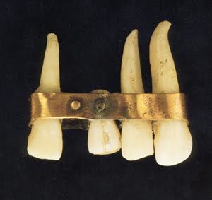 "Ponte" dentario di epoca etrusca. Gli Etruschi furono abilissimi dentisti
